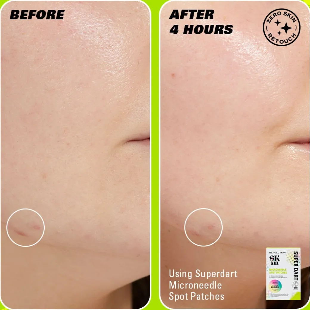 Revolution Skin Super Dart Microneedle Salicylic Acid Hydrocolloid Spot Patches 9 Patches